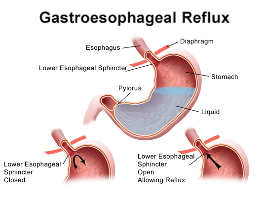 Gastroesophageal Reflux Disease (gerd)