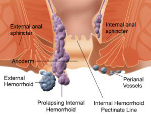 Internal_and_external_hemorrhoids1