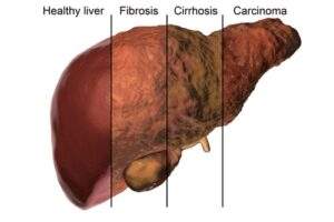 Photo of Liver with lines comparing healthy liver vs. diseased liver