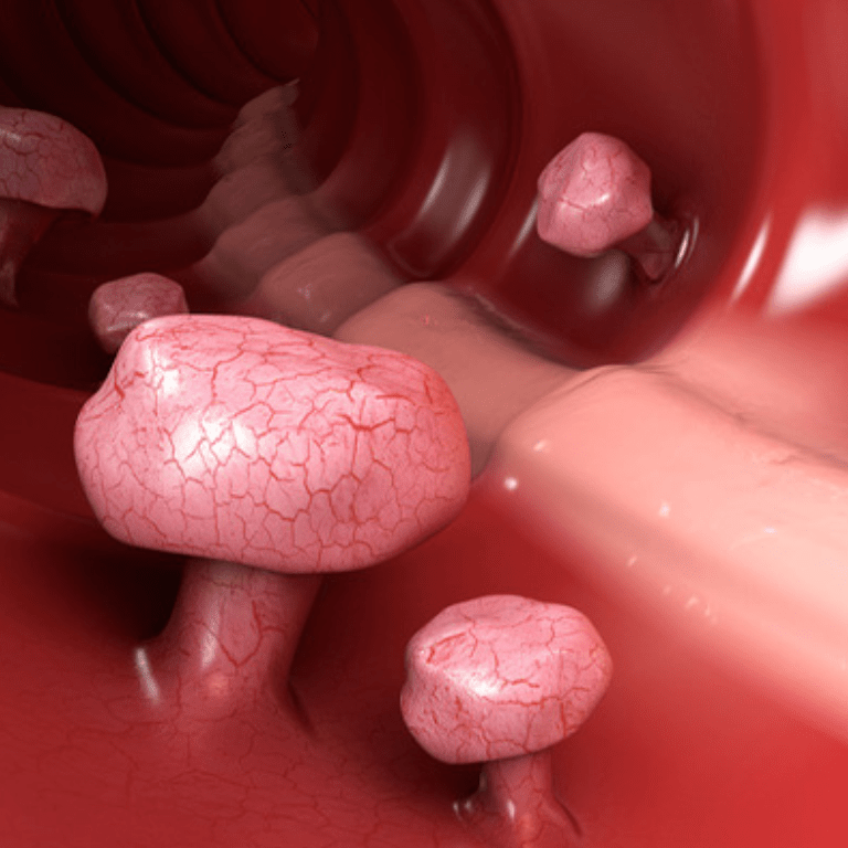 Colonic Polyps Types Causes Treatment And More 58 OFF