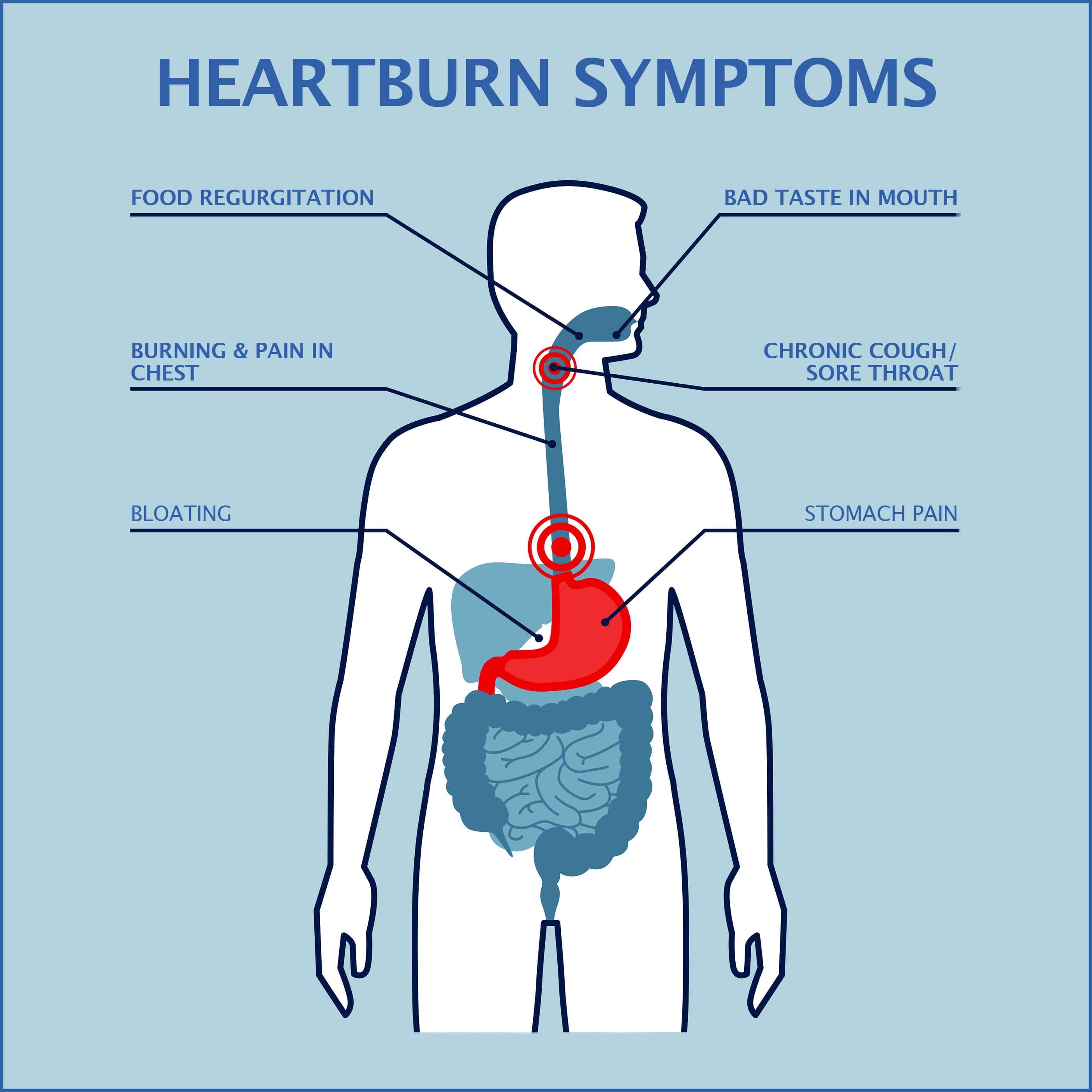Heartburn Graphics min Gastroenterology Of Greater Orlando