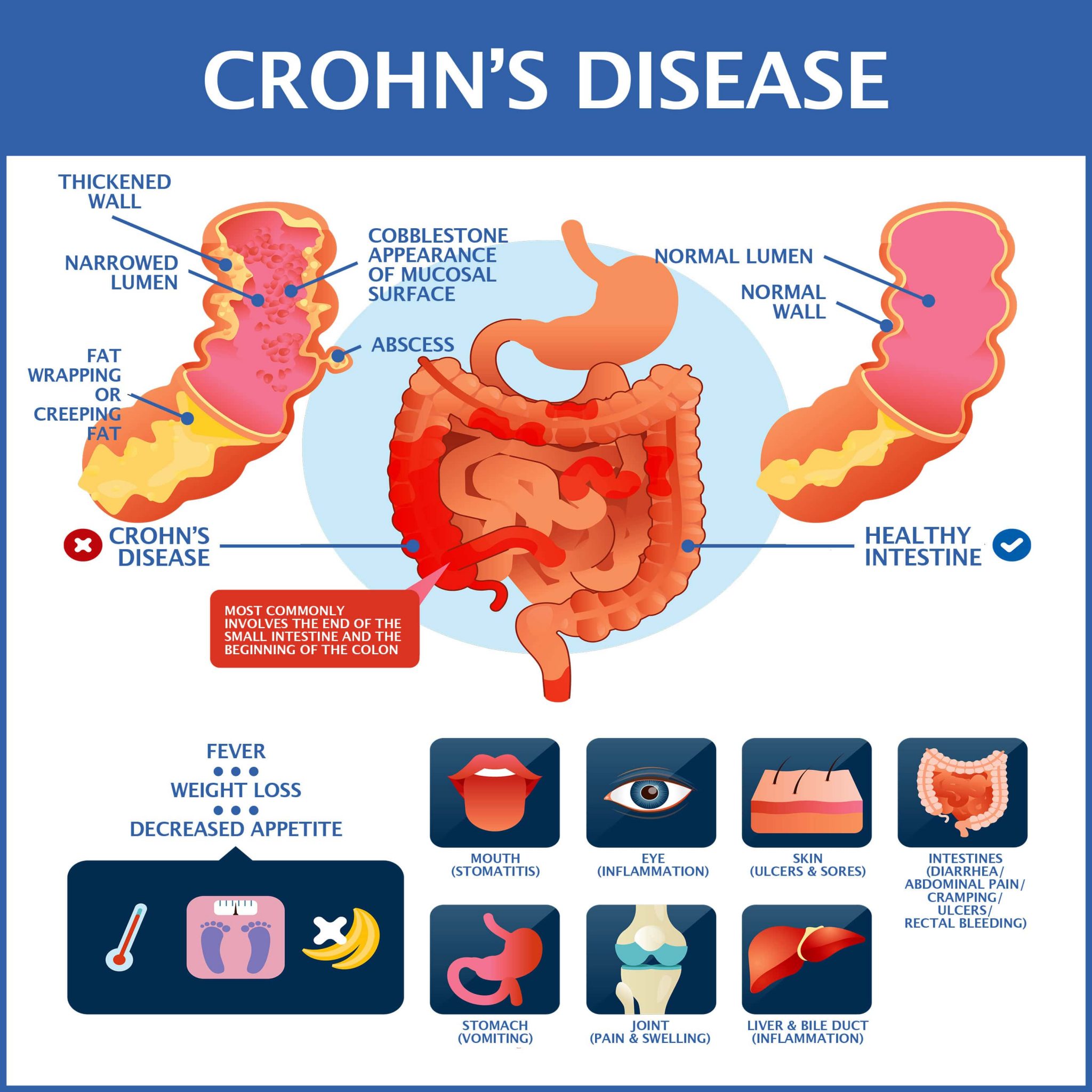 Been Diagnosed With Crohn’s Disease? | Gastroenterology of Greater Orlando