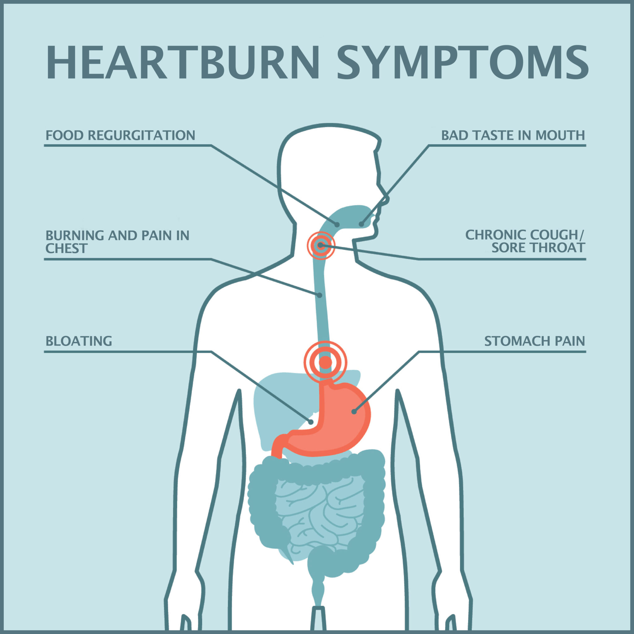 Heartburn Graphics2 1 Gastroenterology Of Greater Orlando   Heartburn Graphics2 1 2048x2048 