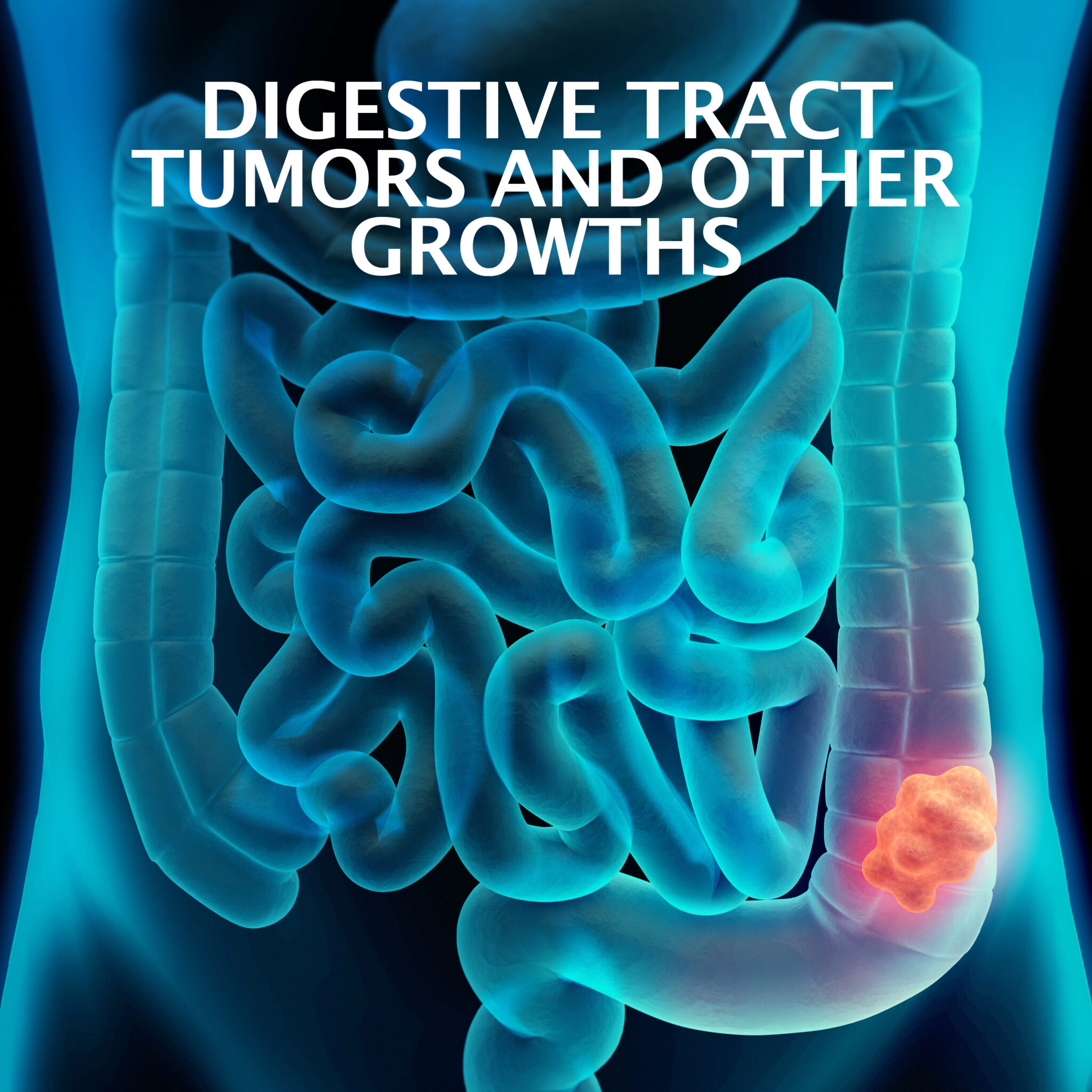 Digestive Tract Tumors and Growths