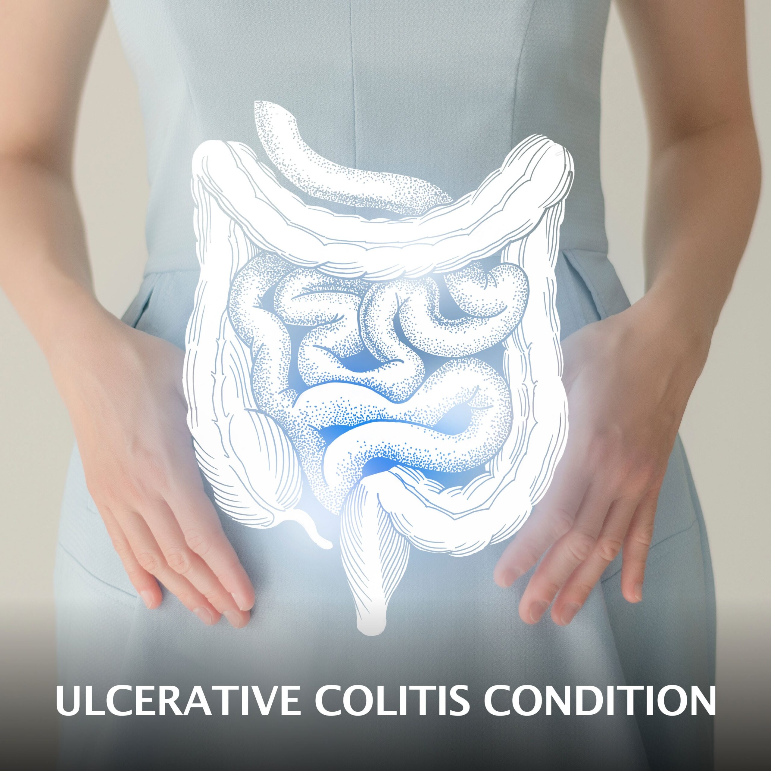 Ulcerative Colitis Condition  Gastroenterology of Greater Orlando