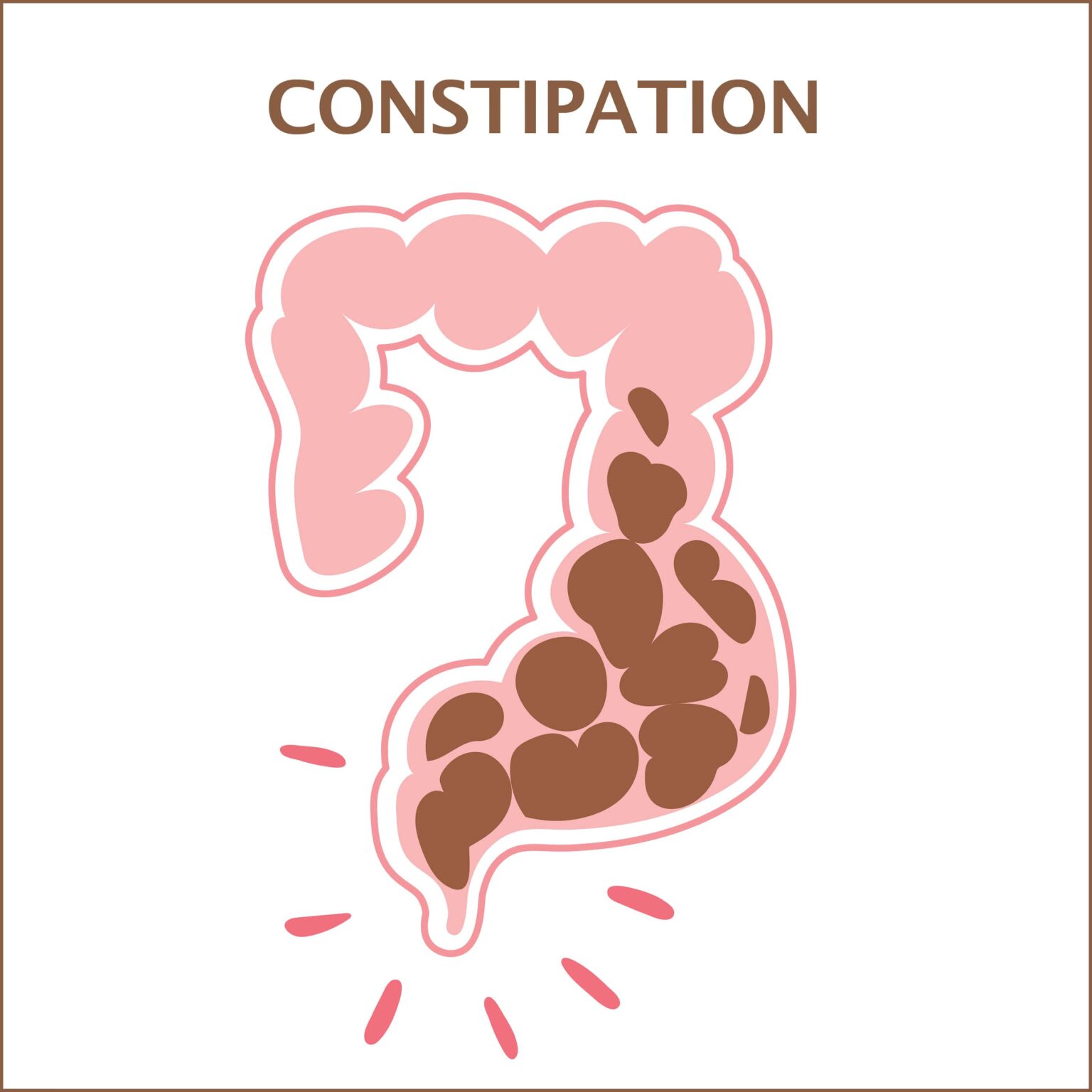 gastrointestinal constipation