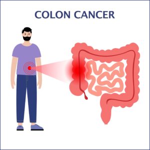 Colon cancer graphic