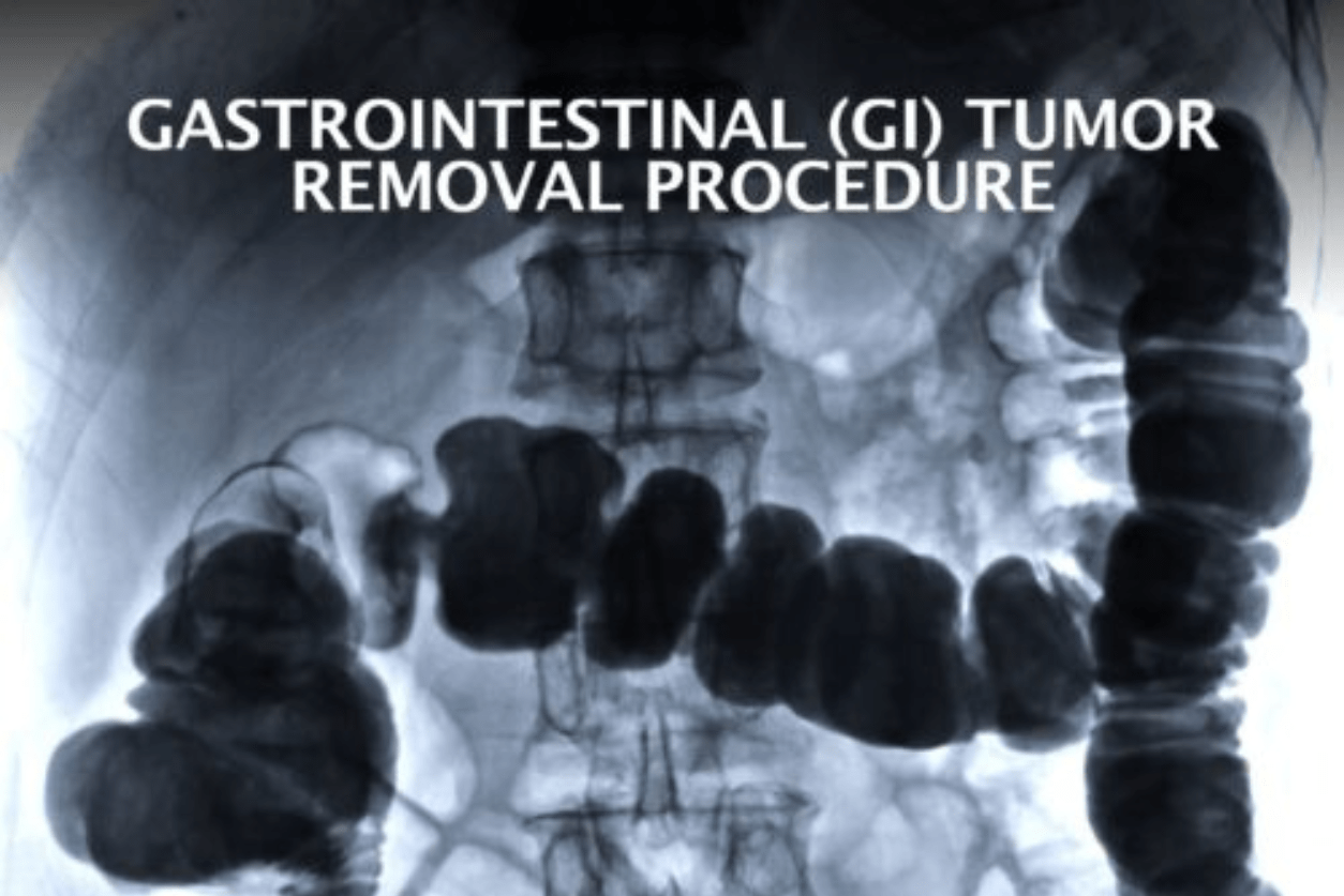GI Tumor Removal Procedure