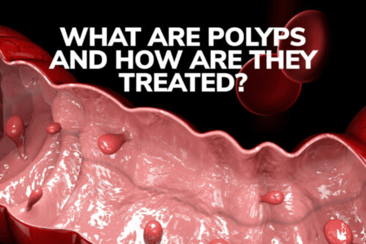 What Are Polyps and How Are They Treated?