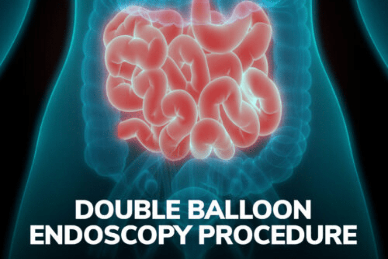 Double Balloon Endoscopy Procedure