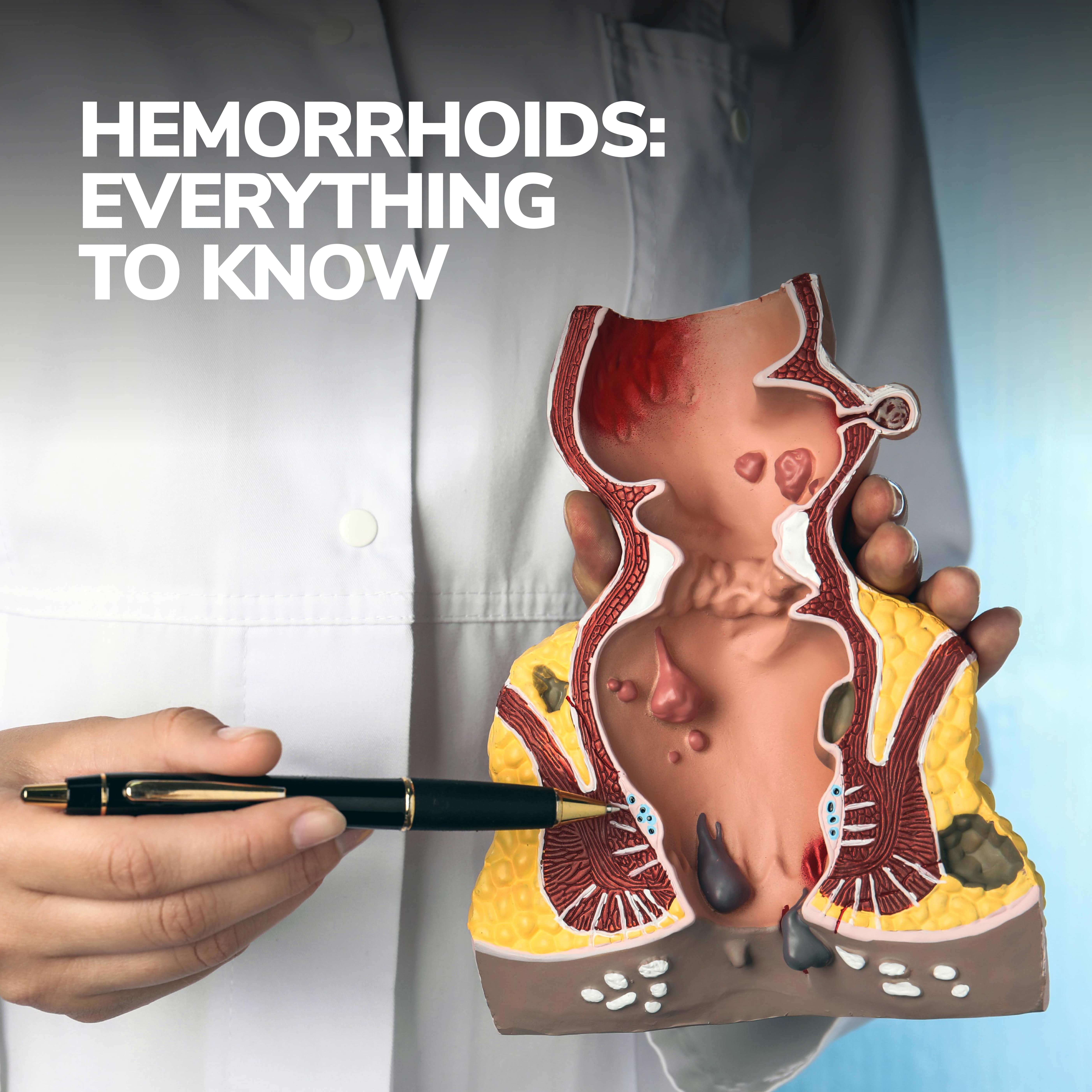 Hemorrhoids: Everything to Know | Gastroenterology Orlando