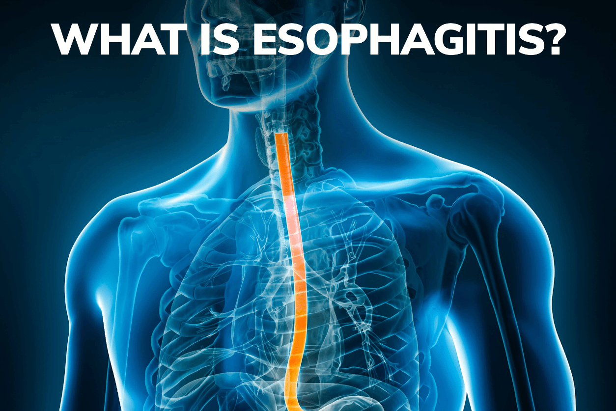Esophagitis