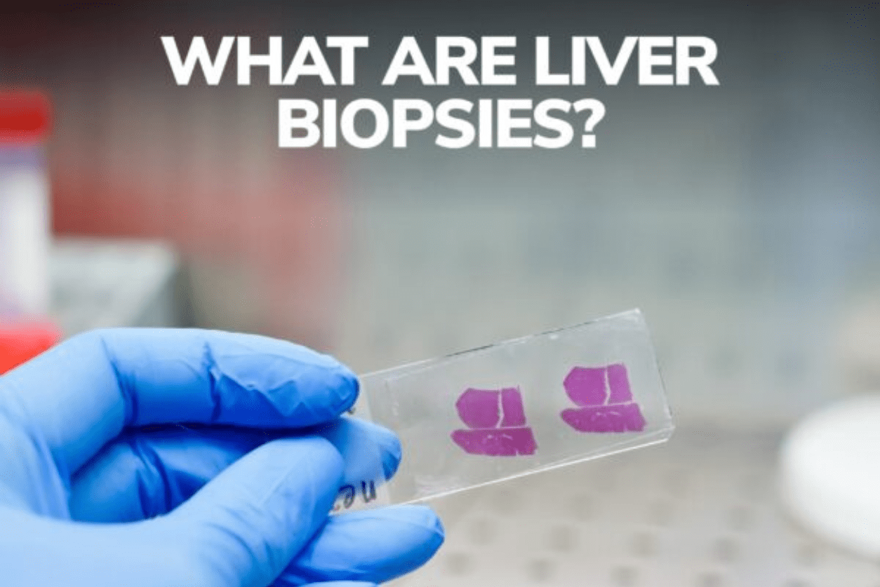 What are Liver Biopsies?