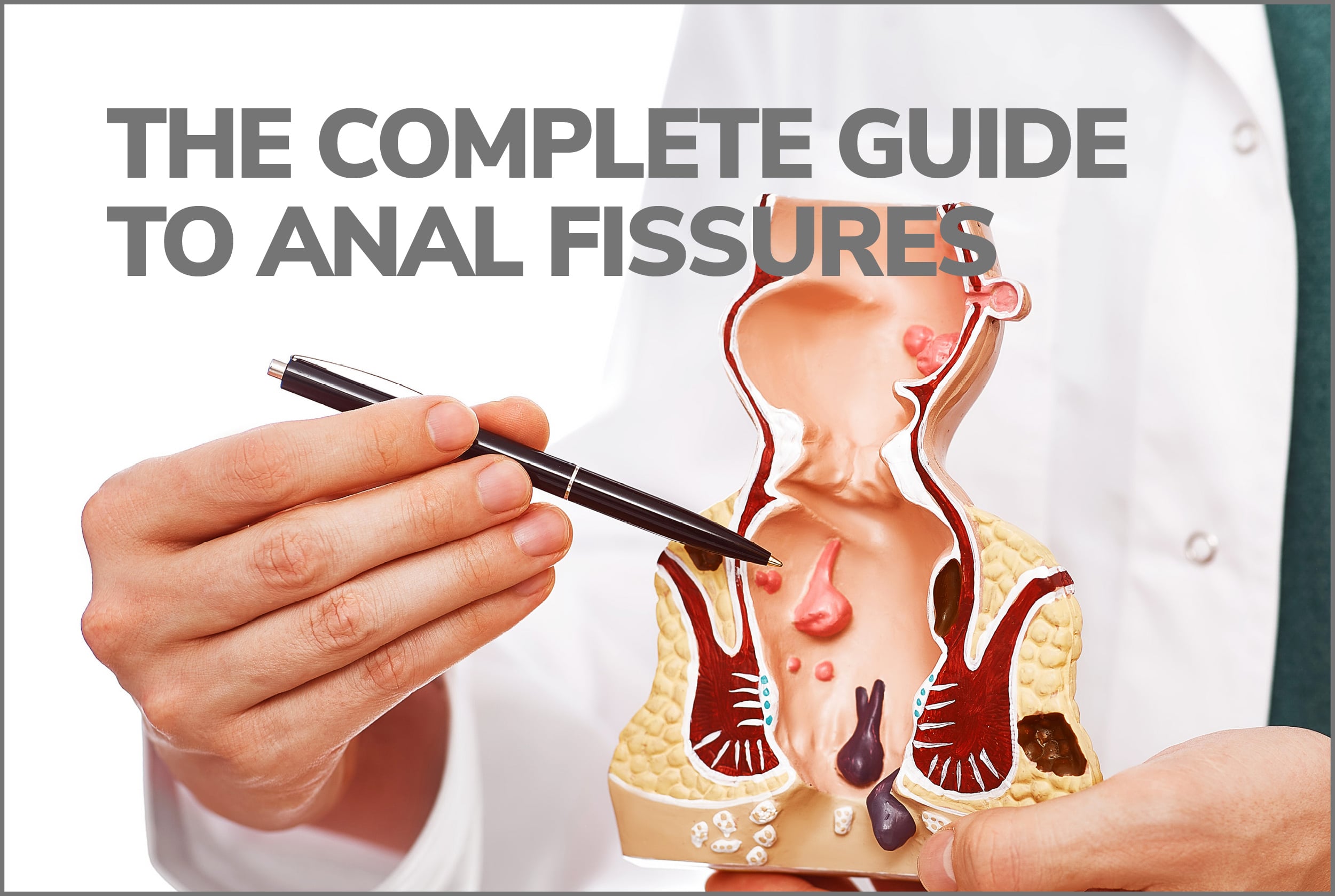 The Complete Guide to Anal Fissures
