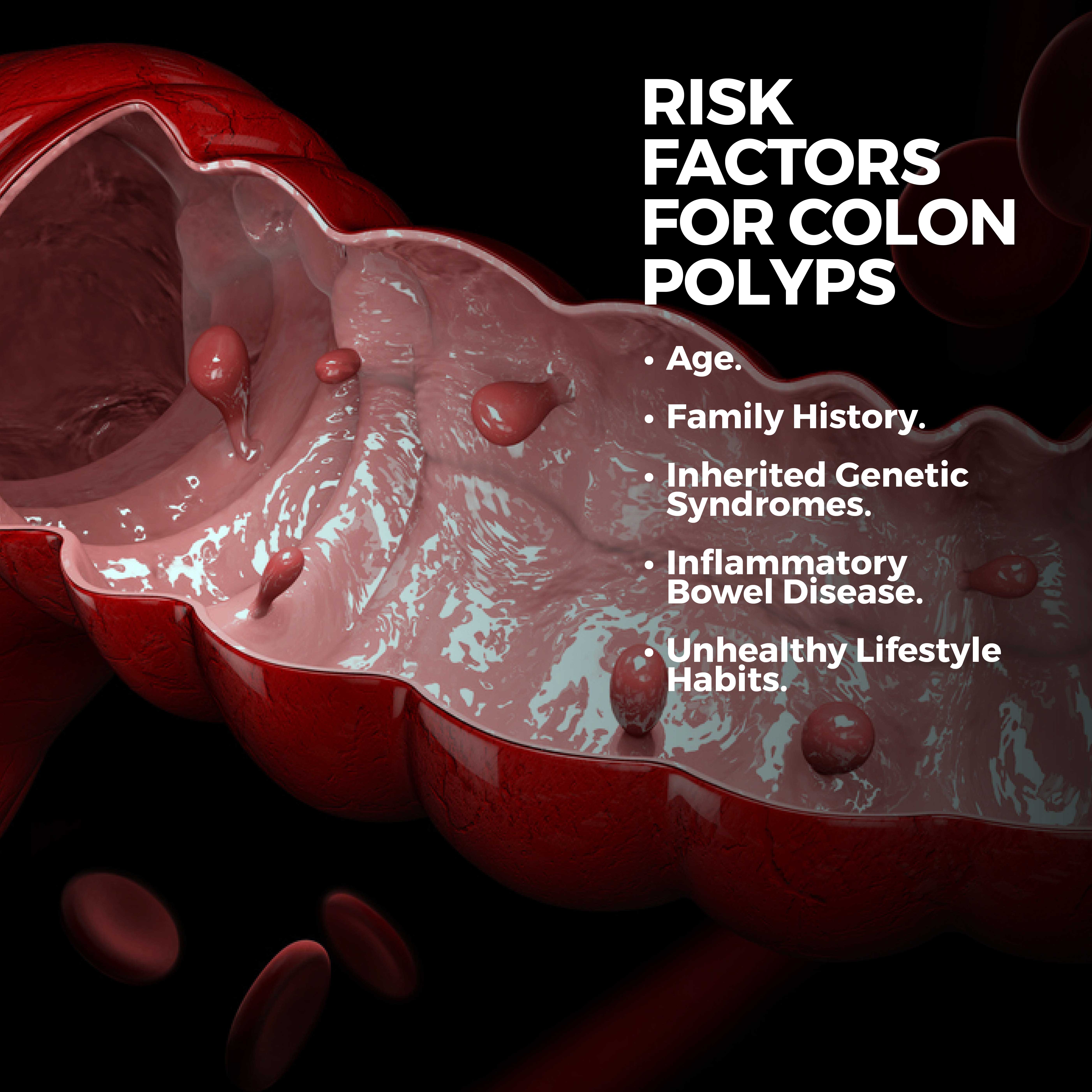 Risk Factors of Colon Polyps