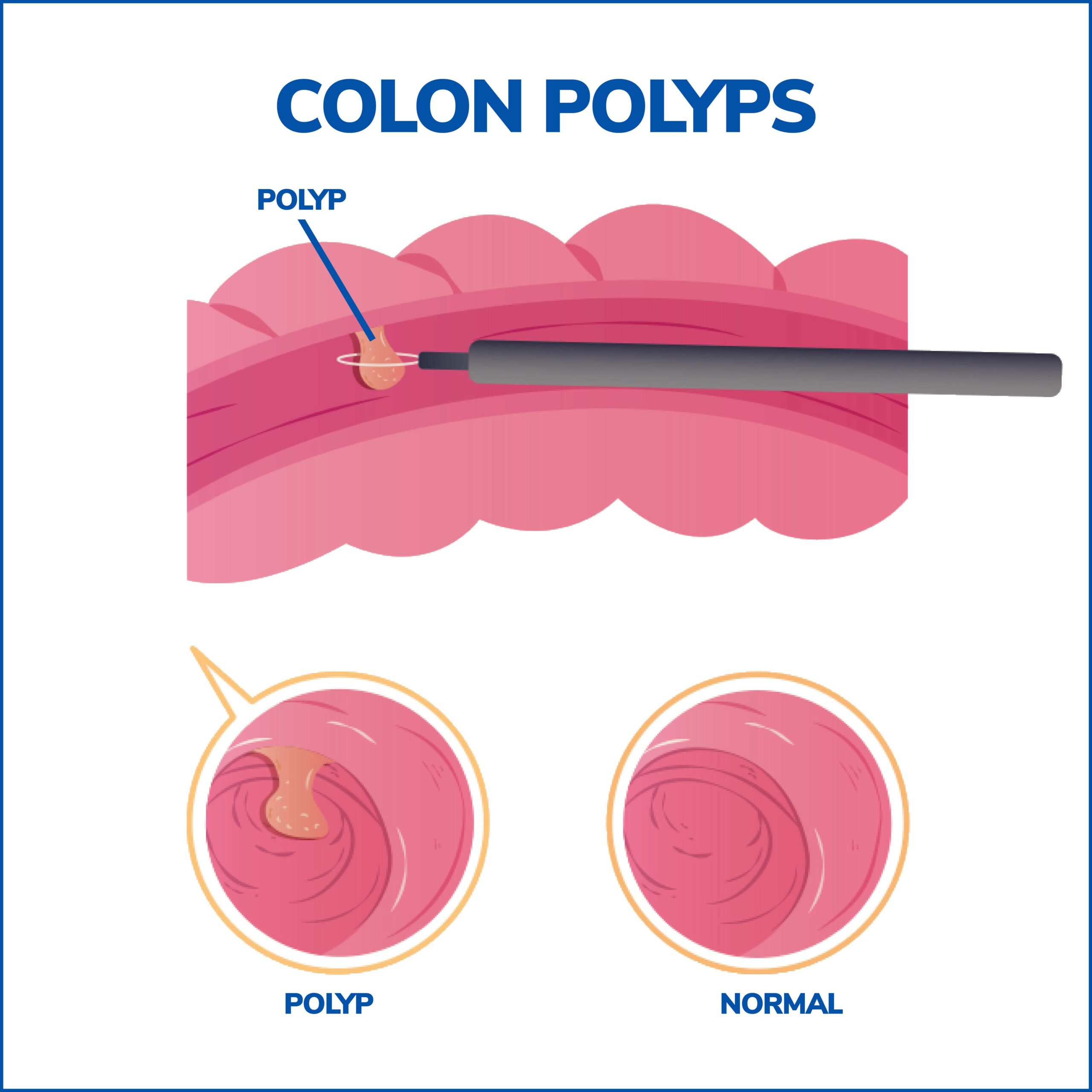 Colon Polyps