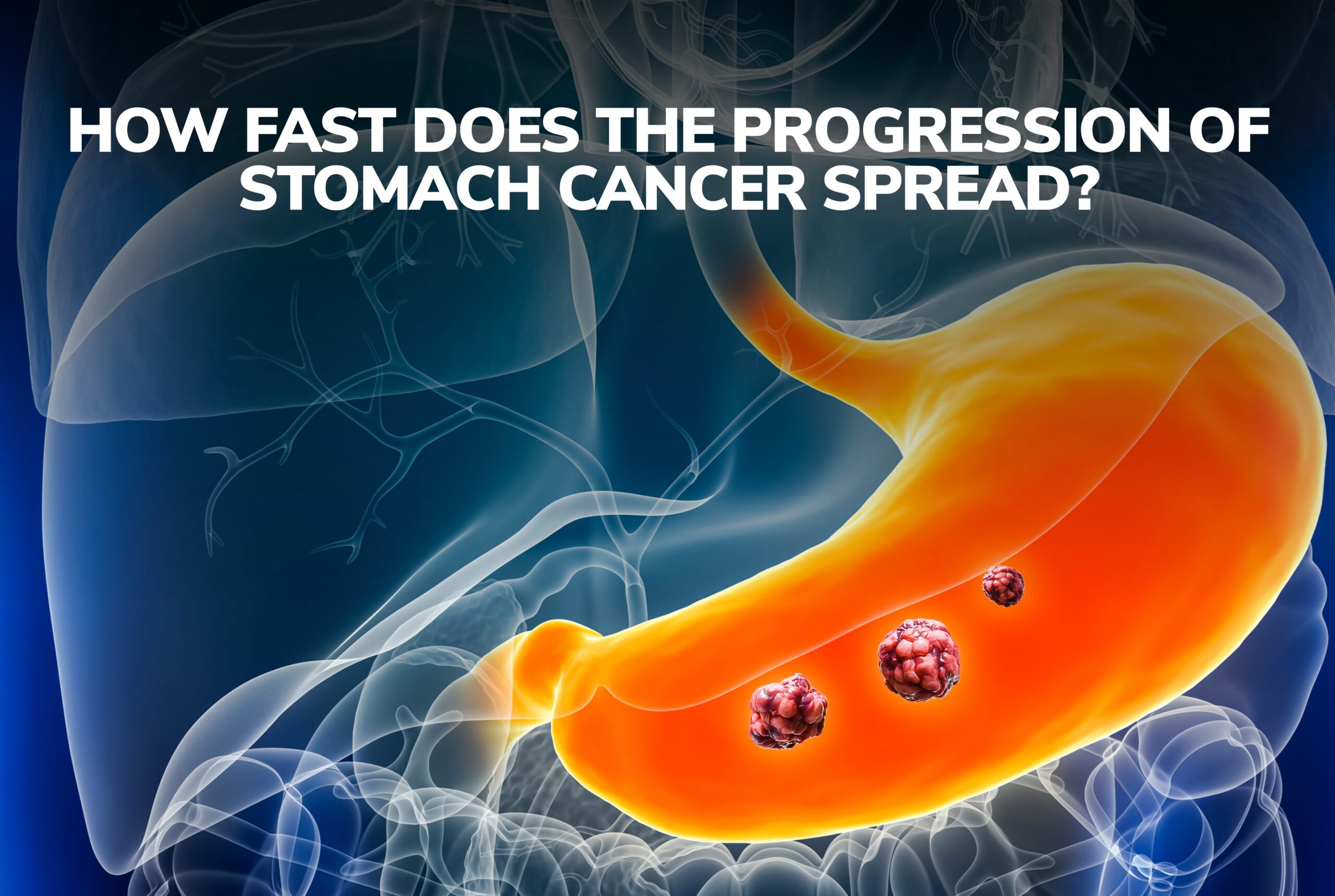 How Fast Does The Progression of Stomach Cancer Spread?