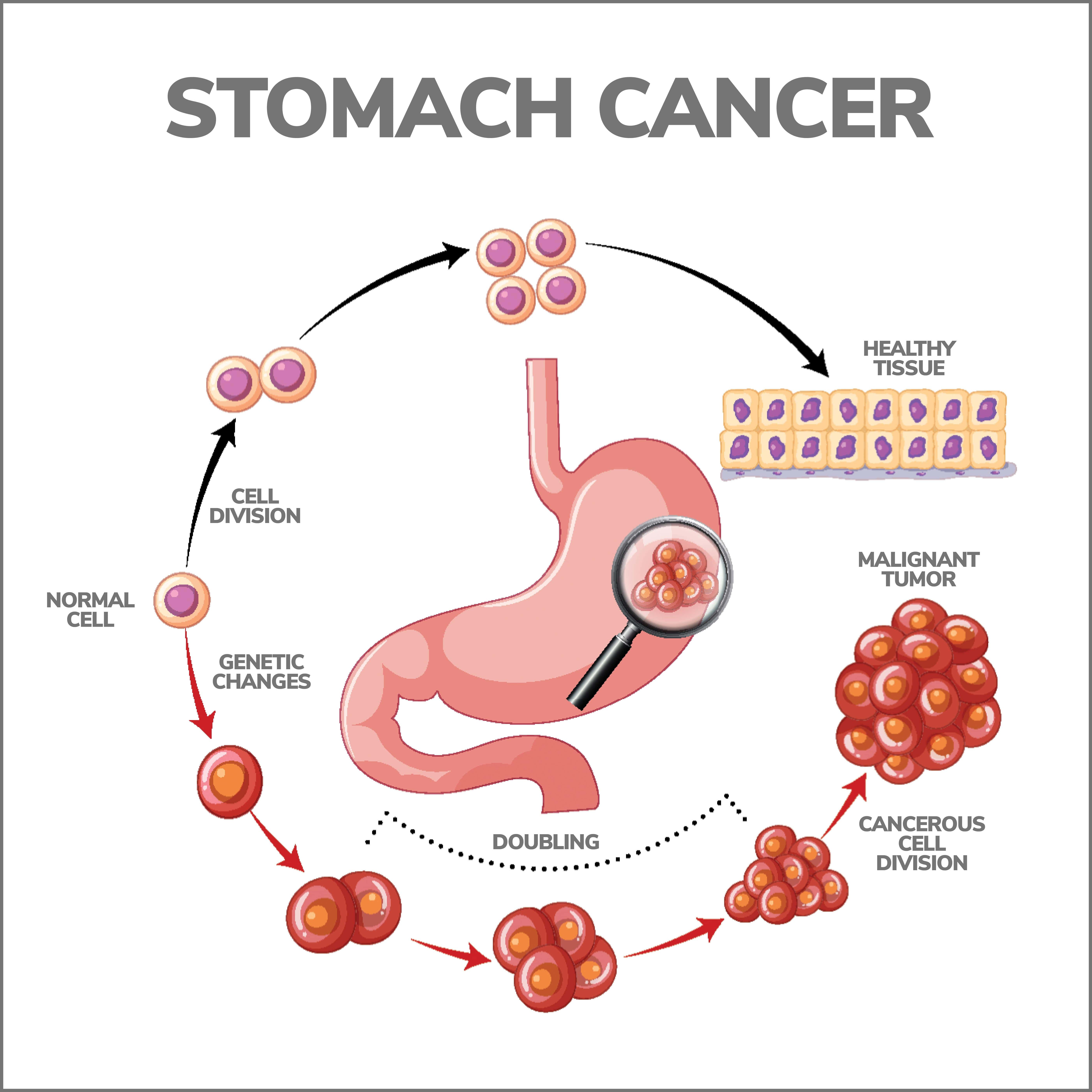 How Fast Does The Progression of Stomach Cancer Spread?