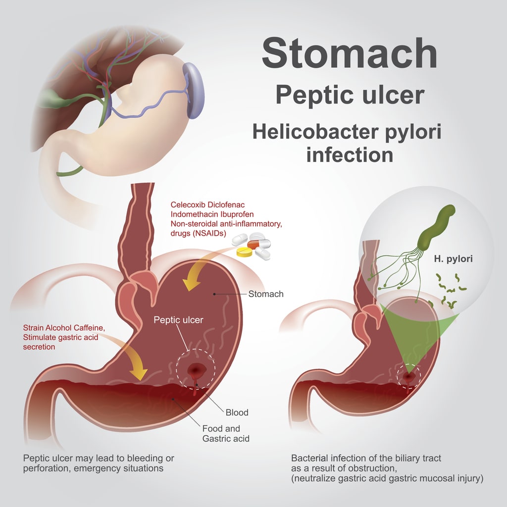 Understanding Duodenal Ulcers: Causes, Symptoms, and Treatment Options for Ulcer Relief