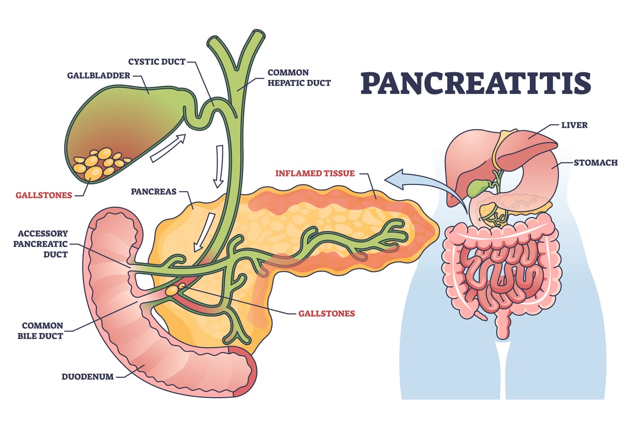 Necrotizing-Pancreatitis
