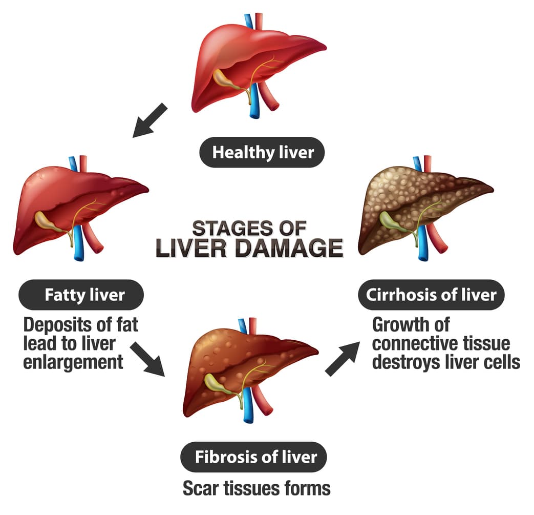 liver disease stages
