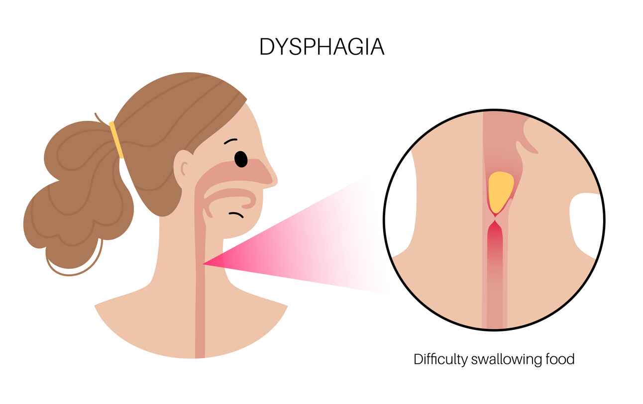 dysphagia anatomy