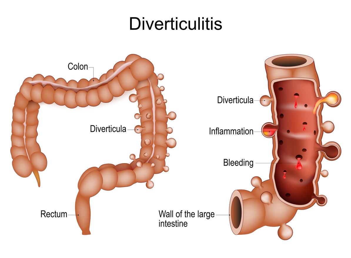 diverticulitis anatomy